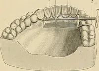 An illustration from The practice of dental medicine / By George F. Eames. Containing thirty-eight engravings and three colored plates. (1899)