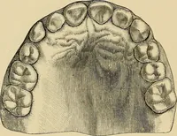 An illustration from The practice of dental medicine / By George F. Eames. Containing thirty-eight engravings and three colored plates. (1899)