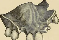 An illustration from The practice of dental medicine / By George F. Eames. Containing thirty-eight engravings and three colored plates. (1899)