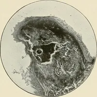 An illustration from Hookworm disease : etiology, pathology, diagnosis, prognosis, prophylaxis, and treatment / by George Dock and Charles C. Bass. Illustrated with forty-nine special engravings and colored plate. (1910)