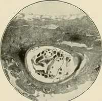 An illustration from Hookworm disease : etiology, pathology, diagnosis, prognosis, prophylaxis, and treatment / by George Dock and Charles C. Bass. Illustrated with forty-nine special engravings and colored plate. (1910)