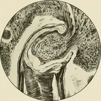 An illustration from Hookworm disease : etiology, pathology, diagnosis, prognosis, prophylaxis, and treatment / by George Dock and Charles C. Bass. Illustrated with forty-nine special engravings and colored plate. (1910)