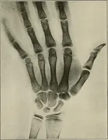 An illustration from Hookworm disease : etiology, pathology, diagnosis, prognosis, prophylaxis, and treatment / by George Dock and Charles C. Bass. Illustrated with forty-nine special engravings and colored plate. (1910)