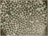 An illustration from Hookworm disease : etiology, pathology, diagnosis, prognosis, prophylaxis, and treatment / by George Dock and Charles C. Bass. Illustrated with forty-nine special engravings and colored plate. (1910)