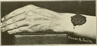 Picture 14 of 38 from Hookworm disease : etiology, pathology, diagnosis, prognosis, prophylaxis, and treatment / by George Dock and Charles C. Bass. Illustrated with forty-nine special engravings and colored plate. (1910), leaf 83