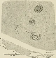 An illustration from Hookworm disease : etiology, pathology, diagnosis, prognosis, prophylaxis, and treatment / by George Dock and Charles C. Bass. Illustrated with forty-nine special engravings and colored plate. (1910)