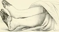 An illustration from A manual of modern surgery, general and operative : With 188 illus. in the text and 13 full-page plates in colors and tints, aggregating 276 separate figures. (1894)