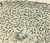An illustration from A manual of modern surgery, general and operative : With 188 illus. in the text and 13 full-page plates in colors and tints, aggregating 276 separate figures. (1894)