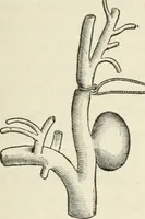 An illustration from A manual of modern surgery, general and operative : With 188 illus. in the text and 13 full-page plates in colors and tints, aggregating 276 separate figures. (1894)