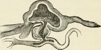 An illustration from A manual of modern surgery, general and operative : With 188 illus. in the text and 13 full-page plates in colors and tints, aggregating 276 separate figures. (1894)