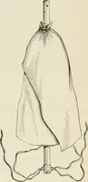 An illustration from A manual of modern surgery, general and operative : With 188 illus. in the text and 13 full-page plates in colors and tints, aggregating 276 separate figures. (1894)