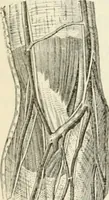 An illustration from A manual of modern surgery, general and operative : With 188 illus. in the text and 13 full-page plates in colors and tints, aggregating 276 separate figures. (1894)