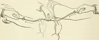 An illustration from A manual of modern surgery, general and operative : With 188 illus. in the text and 13 full-page plates in colors and tints, aggregating 276 separate figures. (1894)
