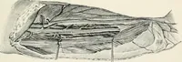 An illustration from A manual of modern surgery, general and operative : With 188 illus. in the text and 13 full-page plates in colors and tints, aggregating 276 separate figures. (1894)
