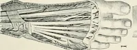 An illustration from A manual of modern surgery, general and operative : With 188 illus. in the text and 13 full-page plates in colors and tints, aggregating 276 separate figures. (1894)