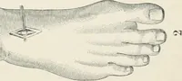 An illustration from A manual of modern surgery, general and operative : With 188 illus. in the text and 13 full-page plates in colors and tints, aggregating 276 separate figures. (1894)