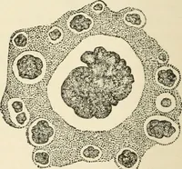 Picture 5 of 135 from A manual of modern surgery, general and operative : With 188 illus. in the text and 13 full-page plates in colors and tints, aggregating 276 separate figures. (1894), leaf 32