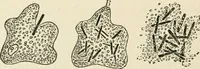 An illustration from A manual of modern surgery, general and operative : With 188 illus. in the text and 13 full-page plates in colors and tints, aggregating 276 separate figures. (1894)
