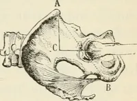 An illustration from A manual of modern surgery, general and operative : With 188 illus. in the text and 13 full-page plates in colors and tints, aggregating 276 separate figures. (1894)