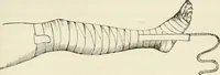 An illustration from A manual of modern surgery, general and operative : With 188 illus. in the text and 13 full-page plates in colors and tints, aggregating 276 separate figures. (1894)