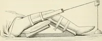 An illustration from A manual of modern surgery, general and operative : With 188 illus. in the text and 13 full-page plates in colors and tints, aggregating 276 separate figures. (1894)