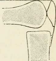 An illustration from A manual of modern surgery, general and operative : With 188 illus. in the text and 13 full-page plates in colors and tints, aggregating 276 separate figures. (1894)