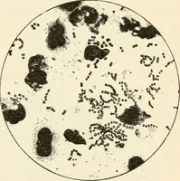 An illustration from A manual of modern surgery, general and operative : With 188 illus. in the text and 13 full-page plates in colors and tints, aggregating 276 separate figures. (1894)