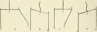 An illustration from A manual of modern surgery, general and operative : With 188 illus. in the text and 13 full-page plates in colors and tints, aggregating 276 separate figures. (1894)