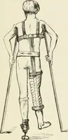 An illustration from A manual of modern surgery, general and operative : With 188 illus. in the text and 13 full-page plates in colors and tints, aggregating 276 separate figures. (1894)