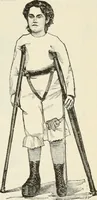 An illustration from A manual of modern surgery, general and operative : With 188 illus. in the text and 13 full-page plates in colors and tints, aggregating 276 separate figures. (1894)