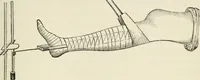 An illustration from A manual of modern surgery, general and operative : With 188 illus. in the text and 13 full-page plates in colors and tints, aggregating 276 separate figures. (1894)