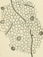 An illustration from A manual of modern surgery, general and operative : With 188 illus. in the text and 13 full-page plates in colors and tints, aggregating 276 separate figures. (1894)