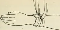 An illustration from A manual of modern surgery, general and operative : With 188 illus. in the text and 13 full-page plates in colors and tints, aggregating 276 separate figures. (1894)