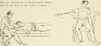 An illustration from A manual of modern surgery, general and operative : With 188 illus. in the text and 13 full-page plates in colors and tints, aggregating 276 separate figures. (1894)
