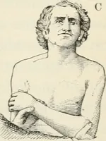 Picture 62 of 135 from A manual of modern surgery, general and operative : With 188 illus. in the text and 13 full-page plates in colors and tints, aggregating 276 separate figures. (1894), leaf 475
