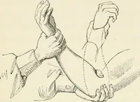 An illustration from A manual of modern surgery, general and operative : With 188 illus. in the text and 13 full-page plates in colors and tints, aggregating 276 separate figures. (1894)