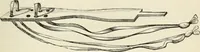 An illustration from A manual of modern surgery, general and operative : With 188 illus. in the text and 13 full-page plates in colors and tints, aggregating 276 separate figures. (1894)