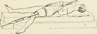 An illustration from A manual of modern surgery, general and operative : With 188 illus. in the text and 13 full-page plates in colors and tints, aggregating 276 separate figures. (1894)