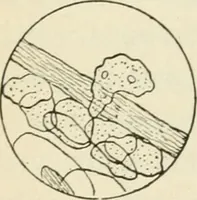 An illustration from A manual of modern surgery, general and operative : With 188 illus. in the text and 13 full-page plates in colors and tints, aggregating 276 separate figures. (1894)