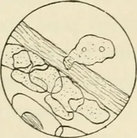 An illustration from A manual of modern surgery, general and operative : With 188 illus. in the text and 13 full-page plates in colors and tints, aggregating 276 separate figures. (1894)