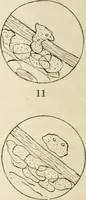 Picture 17 of 135 from A manual of modern surgery, general and operative : With 188 illus. in the text and 13 full-page plates in colors and tints, aggregating 276 separate figures. (1894), leaf 50
