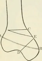 An illustration from A manual of modern surgery, general and operative : With 188 illus. in the text and 13 full-page plates in colors and tints, aggregating 276 separate figures. (1894)