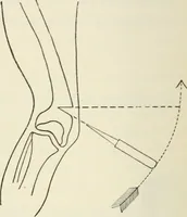 An illustration from A manual of modern surgery, general and operative : With 188 illus. in the text and 13 full-page plates in colors and tints, aggregating 276 separate figures. (1894)