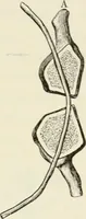 Picture 74 of 135 from A manual of modern surgery, general and operative : With 188 illus. in the text and 13 full-page plates in colors and tints, aggregating 276 separate figures. (1894), leaf 507