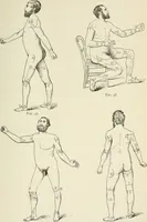An illustration from A manual of modern surgery, general and operative : With 188 illus. in the text and 13 full-page plates in colors and tints, aggregating 276 separate figures. (1894)