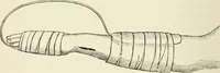 An illustration from A manual of modern surgery, general and operative : With 188 illus. in the text and 13 full-page plates in colors and tints, aggregating 276 separate figures. (1894)