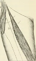 An illustration from A manual of modern surgery, general and operative : With 188 illus. in the text and 13 full-page plates in colors and tints, aggregating 276 separate figures. (1894)