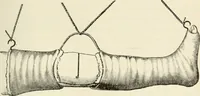 An illustration from A manual of modern surgery, general and operative : With 188 illus. in the text and 13 full-page plates in colors and tints, aggregating 276 separate figures. (1894)