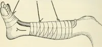 An illustration from A manual of modern surgery, general and operative : With 188 illus. in the text and 13 full-page plates in colors and tints, aggregating 276 separate figures. (1894)