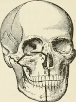 An illustration from A manual of modern surgery, general and operative : With 188 illus. in the text and 13 full-page plates in colors and tints, aggregating 276 separate figures. (1894)